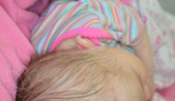 Before Newborn Ear Correction