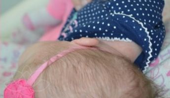 After Newborn Ear Correction