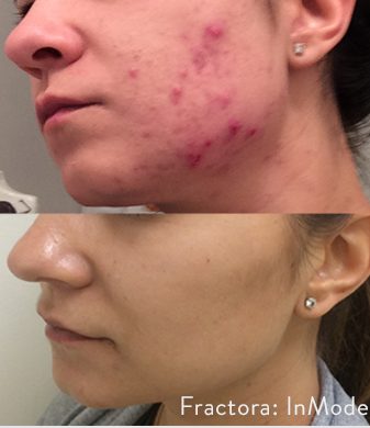 Diminish acne scars with Fractora