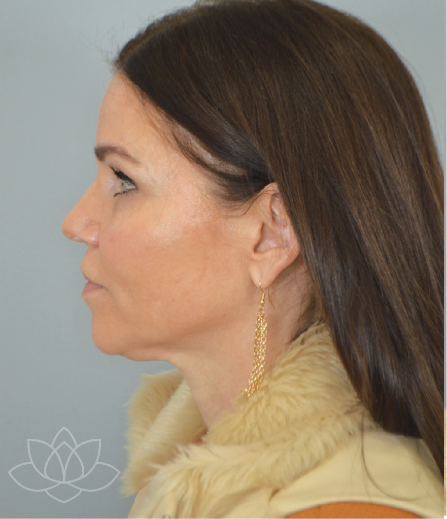 facelift procedures for mature women