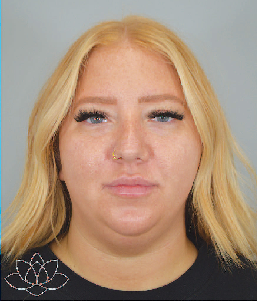 submental liposuction to treat a double chin