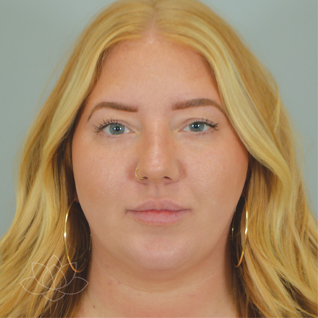 submental liposuction to treat a double chin