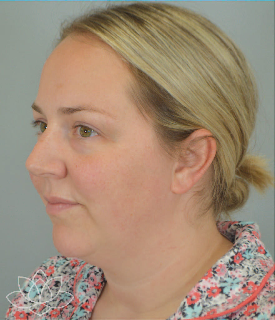 submental liposuction to treat a double chin