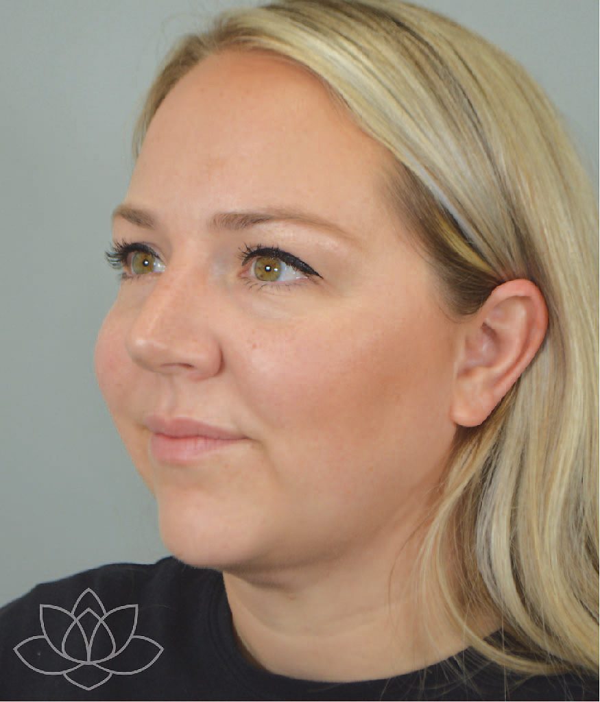 submental liposuction to treat a double chin