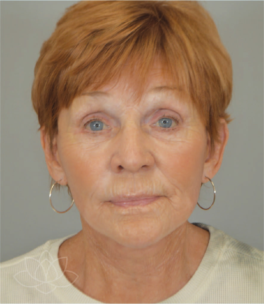 facelift procedures for mature women