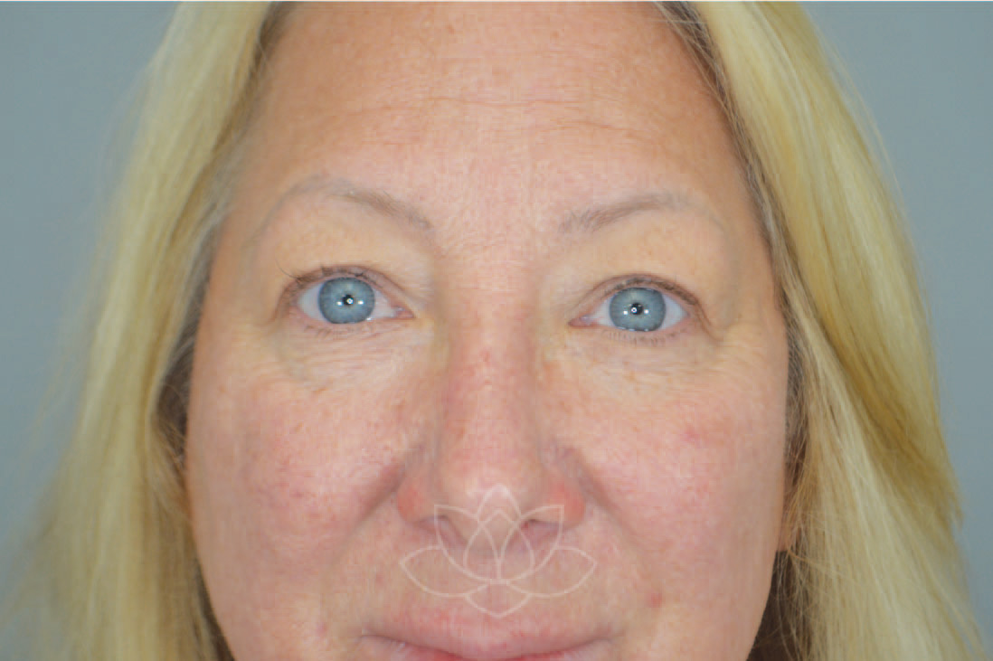 eyelid surgery for the aging face