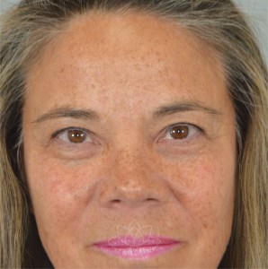 browlift for aging eyes