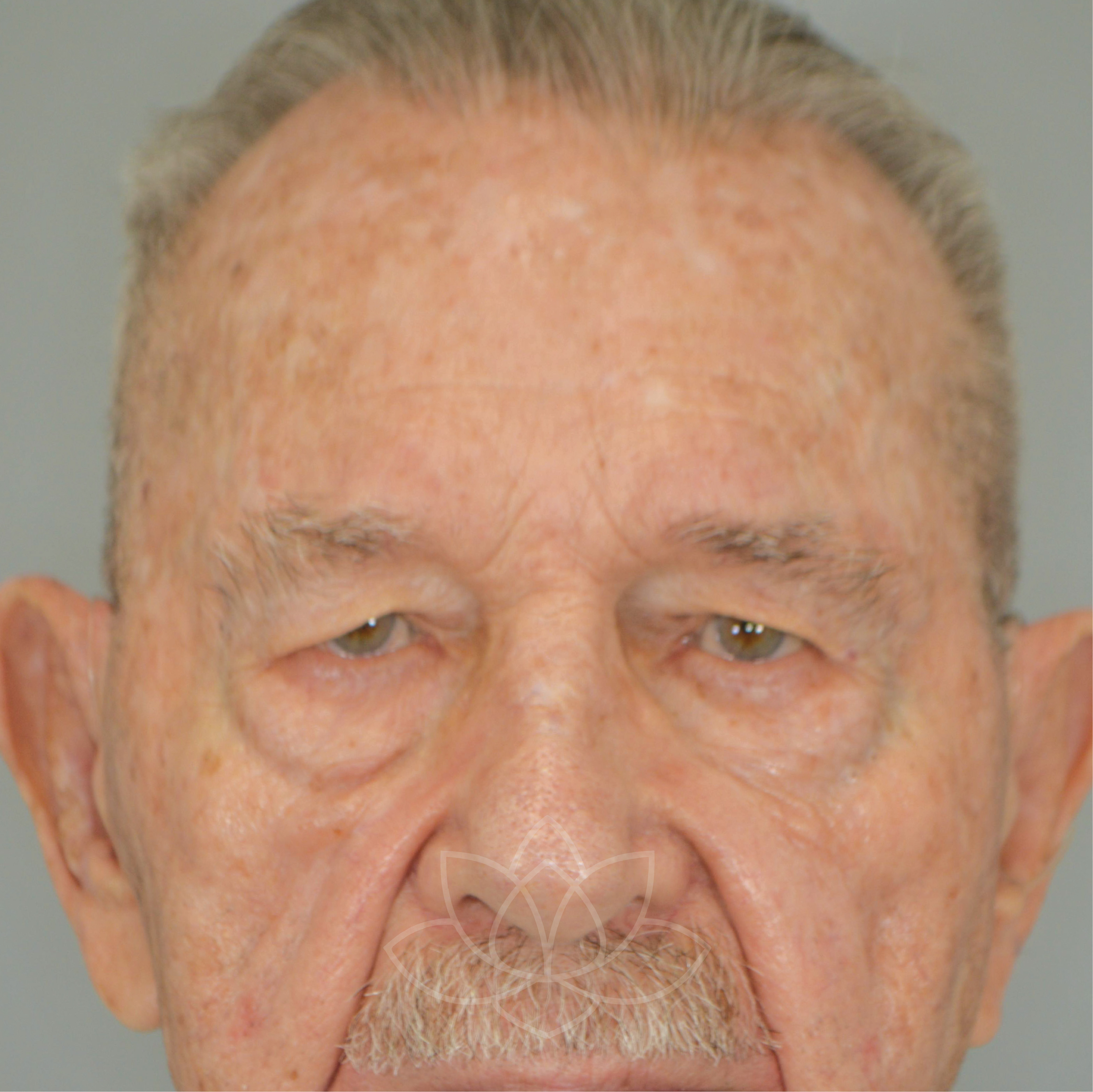 eyelid surgery for the aging face