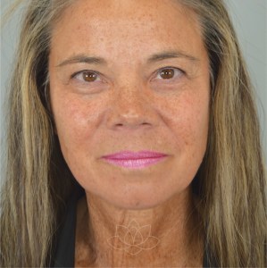 facelift procedures for mature women