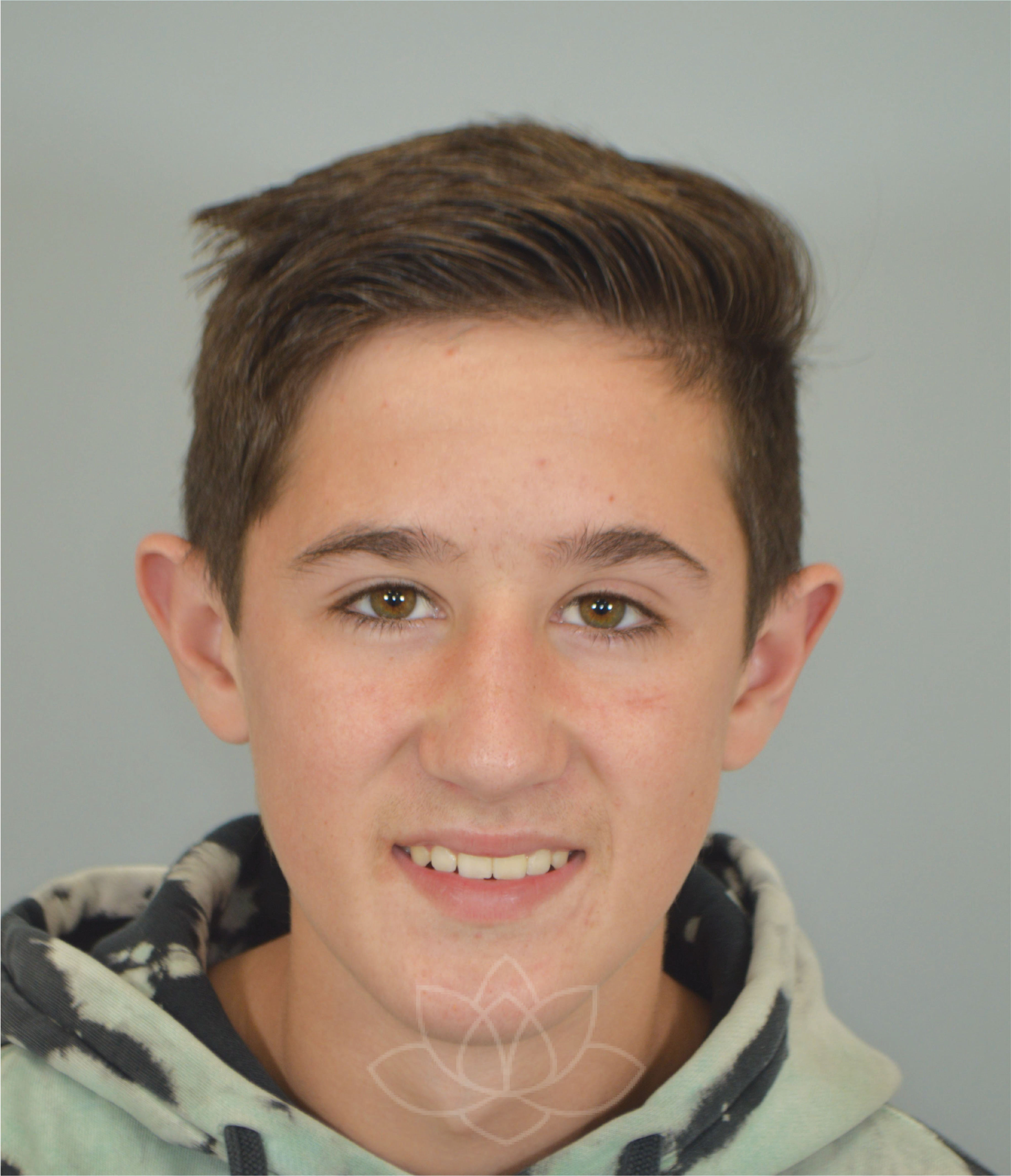 Otoplasty at Desert Bloom Plastic Surgery