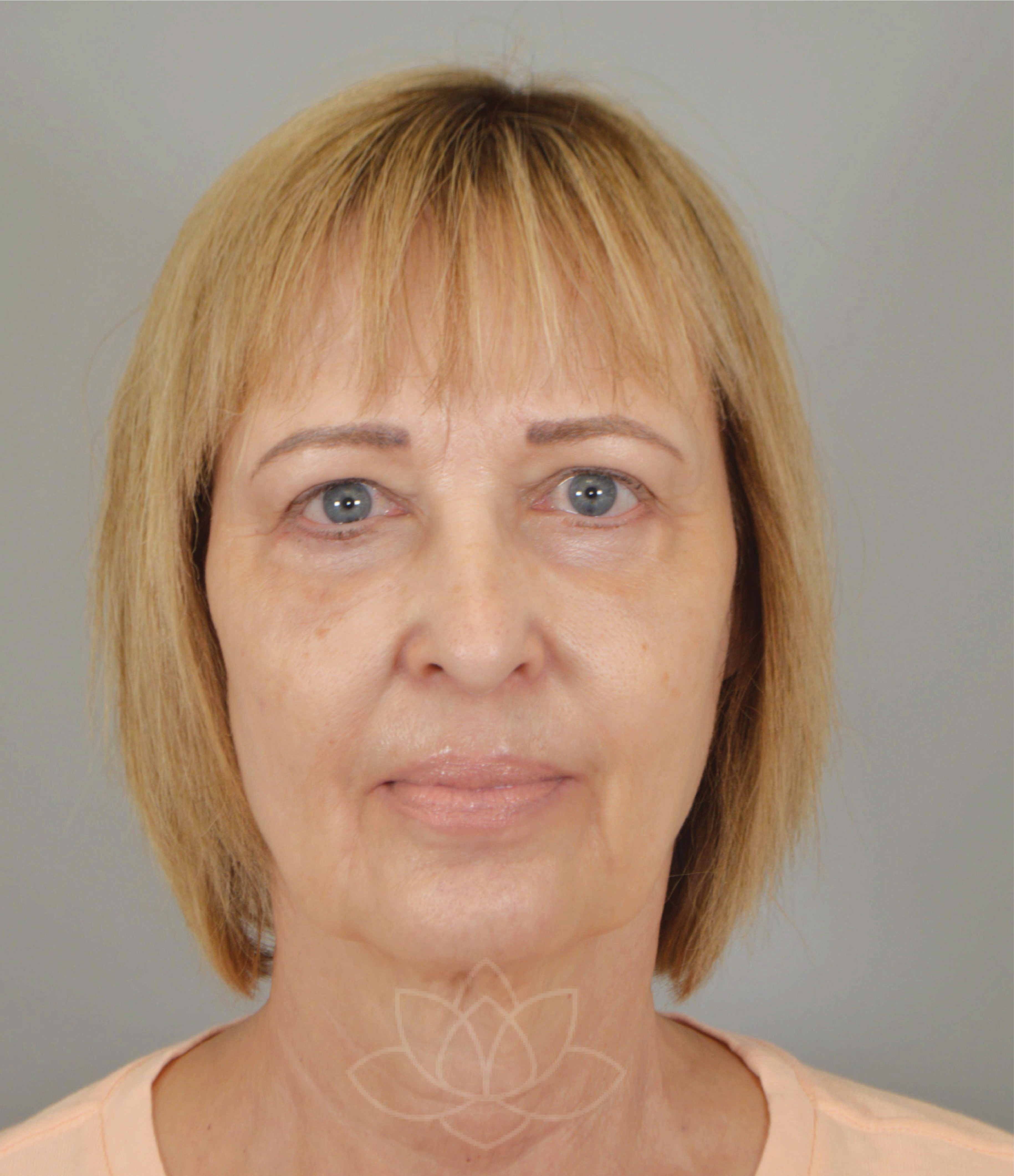 eyelid surgery at Desert Bloom Plastic Surgery