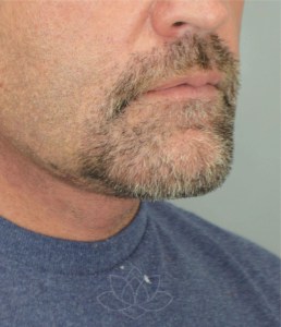 chin implant and neck lift at Desert Bloom Plastic Surgery