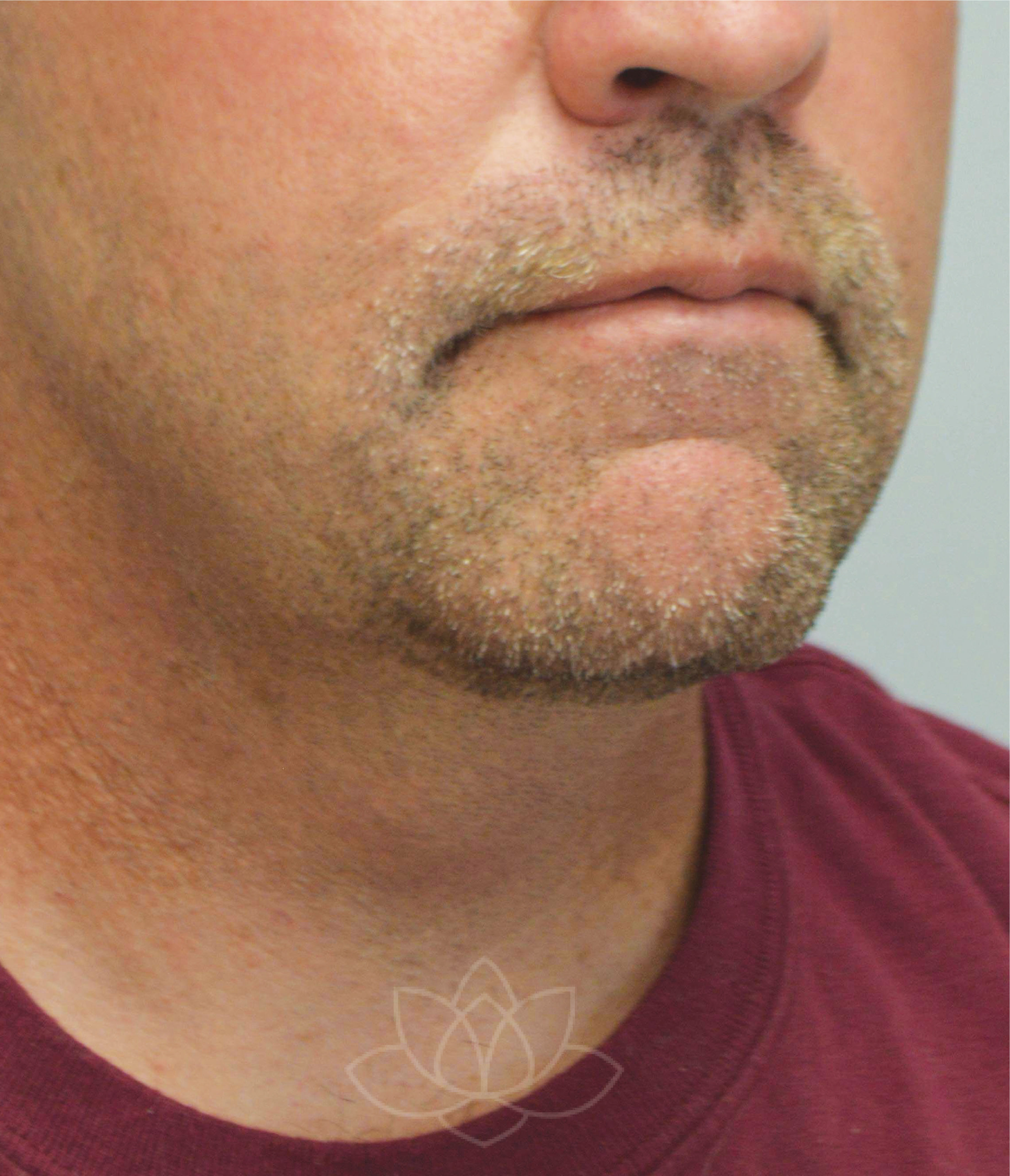 chin implant and neck lift