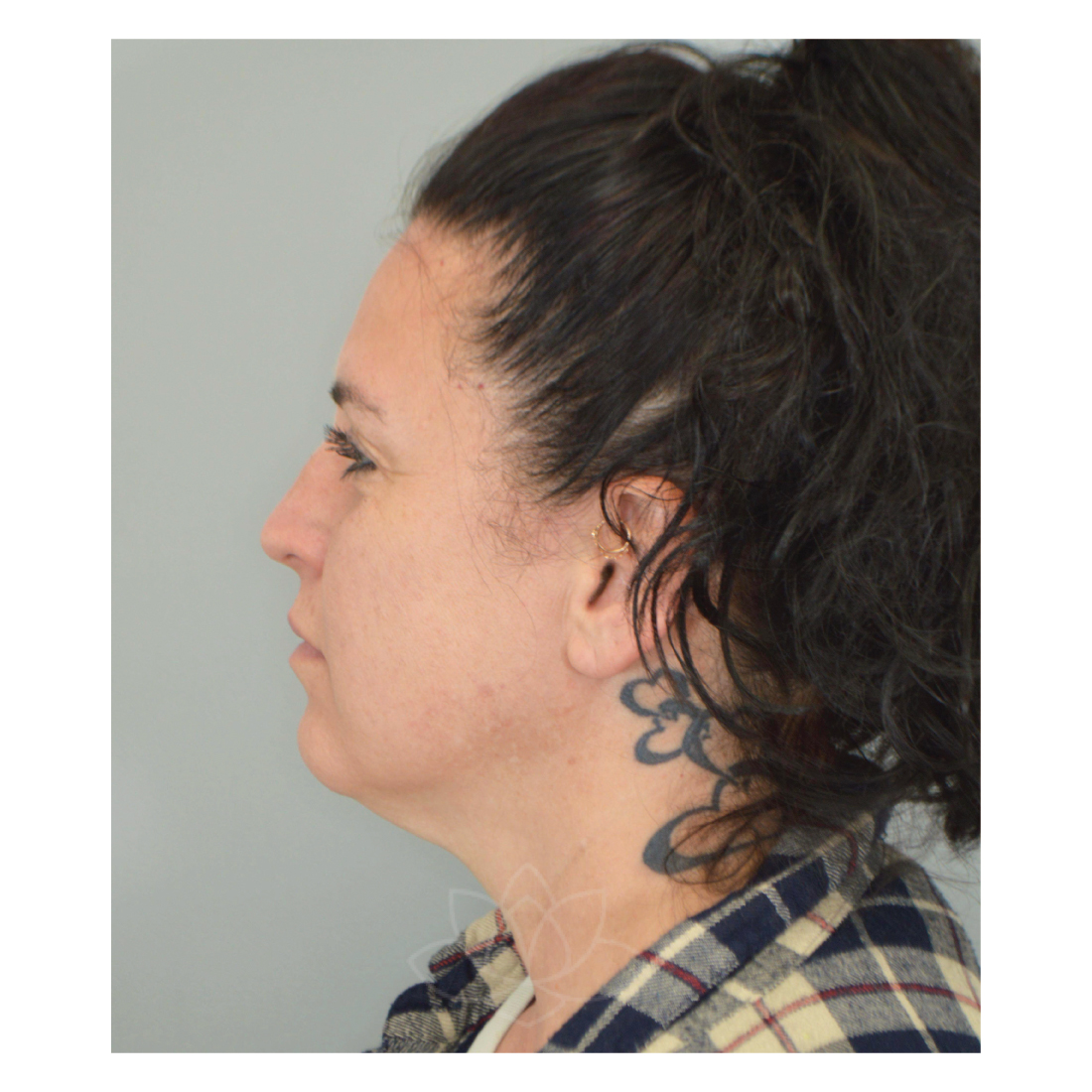 neck lift and submental liposuction at Desert Bloom Plastic Surgery