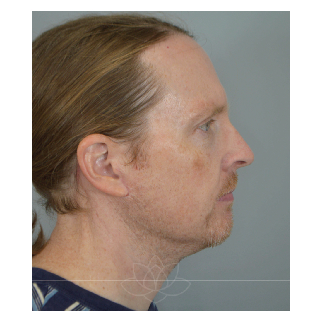 neck lift and submental liposuction at Desert Bloom Plastic Surgery