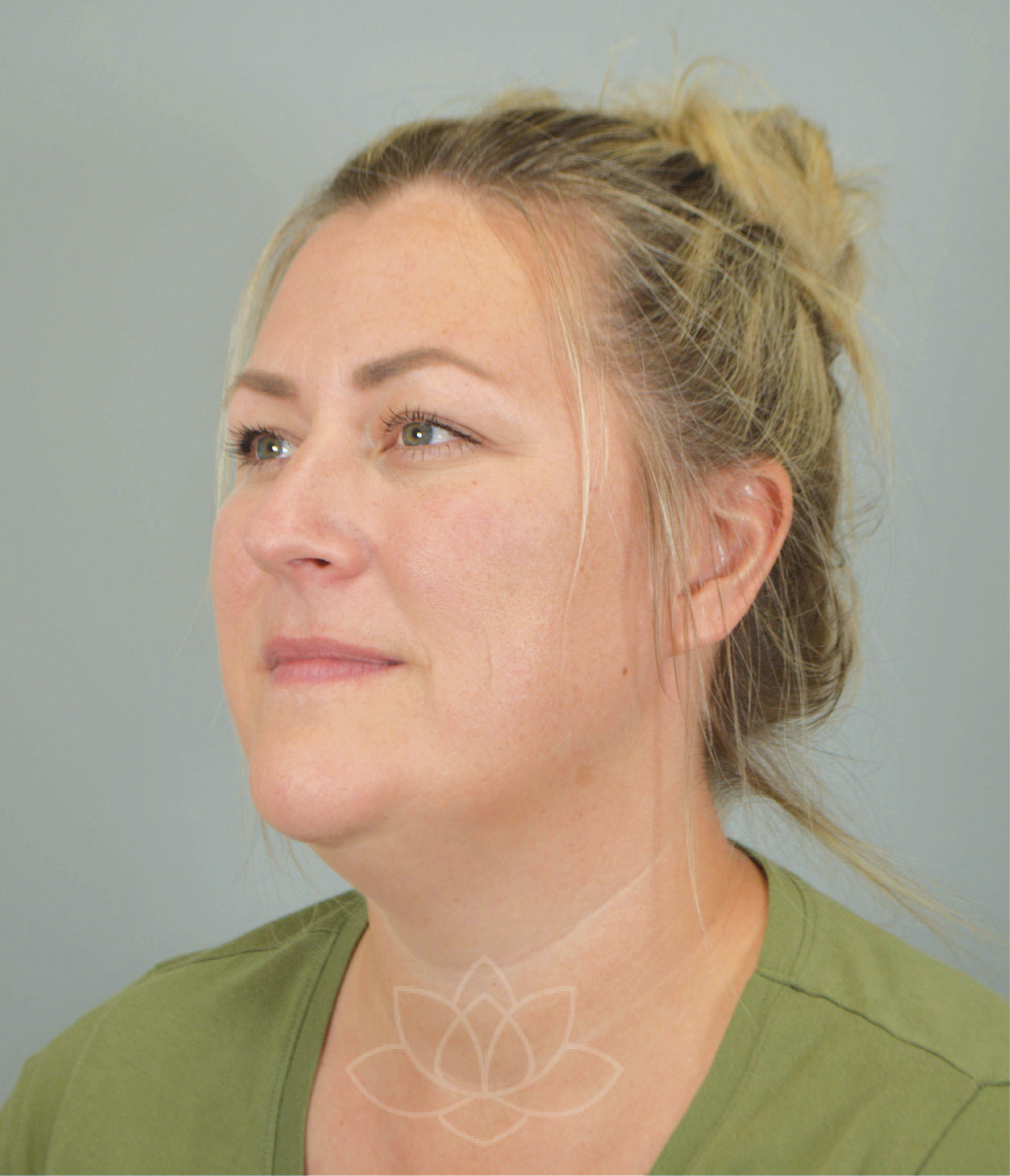 submental liposuction and platysma plication