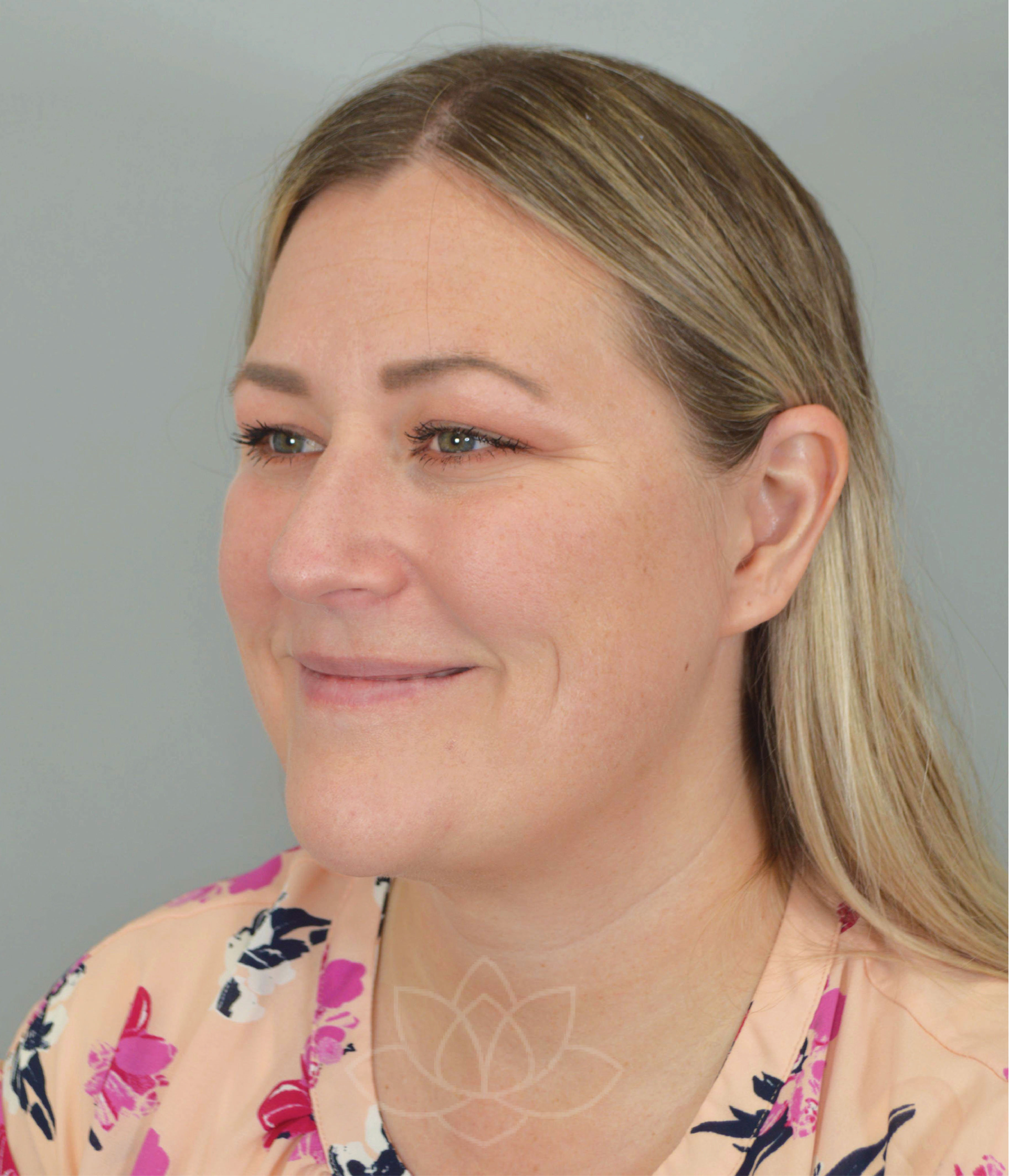 submental liposuction and platysma plication