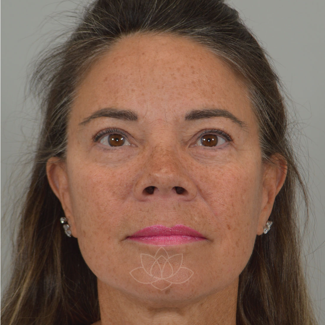 Eyelid Surgery After