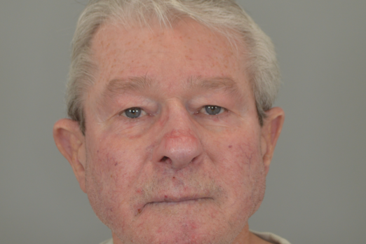 3 Month Post-op Rhinophyma 1