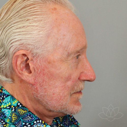 Neck Liposuction After