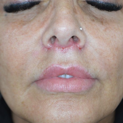 After Lip Lift 1 Week Post-op