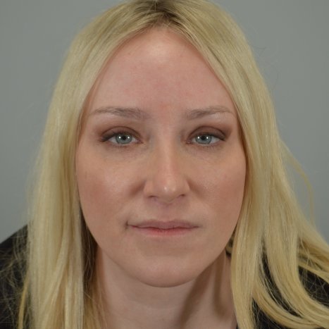 After Lip Lift 3 months post-op