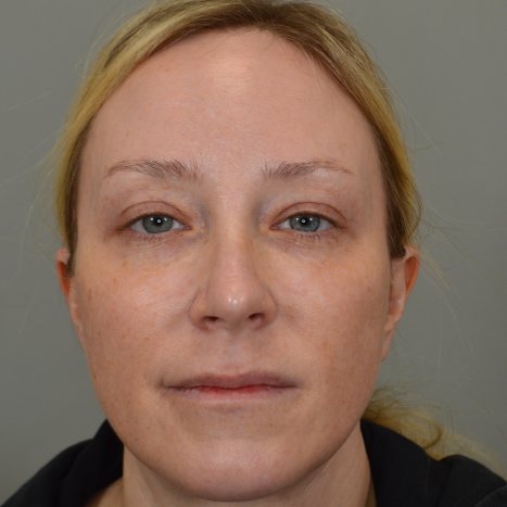 Before Lip lift pre-op. Patient 1