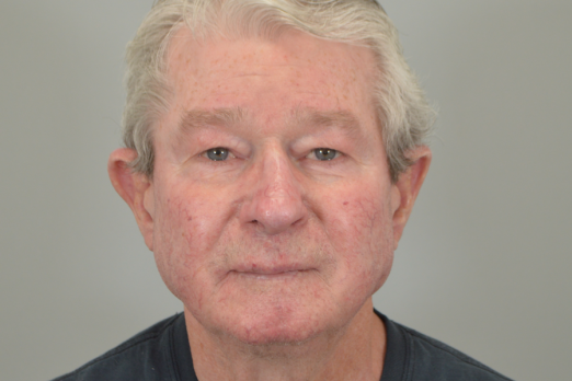 4 Months Post Op Rhinophyma