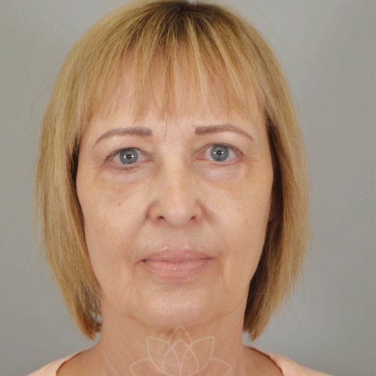 eyelid surgery at Desert Bloom Plastic Surgery