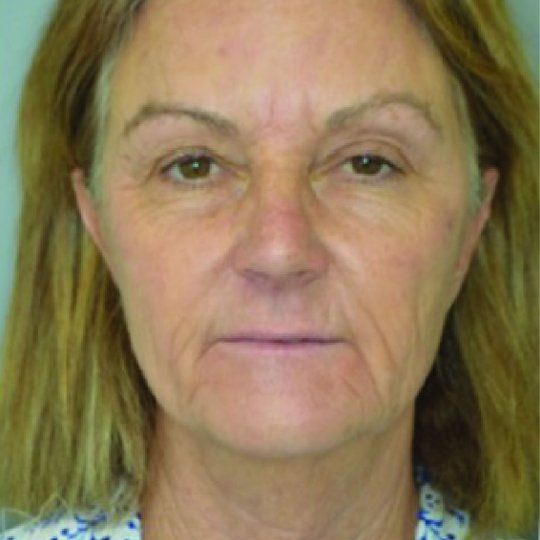 Eyelid Surgery Before