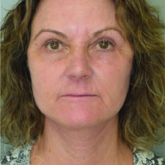 Eyelid Surgery After