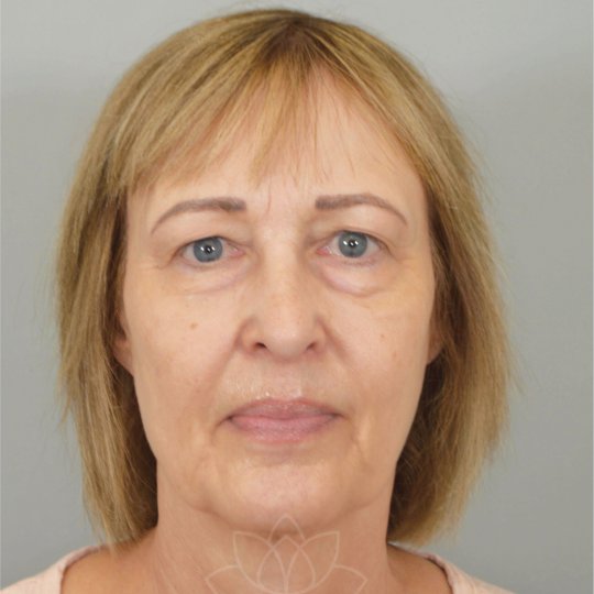 eyelid surgery at Desert Bloom Plastic Surgery