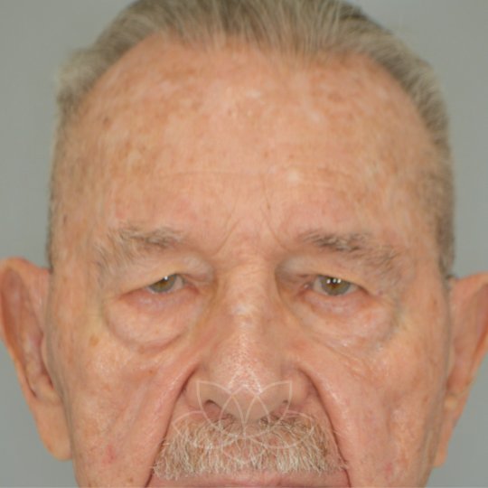 eyelid surgery for the aging face