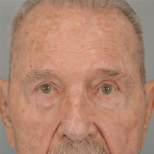 eyelid surgery for the aging face