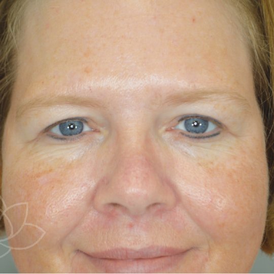 eyelid surgery for the aging face