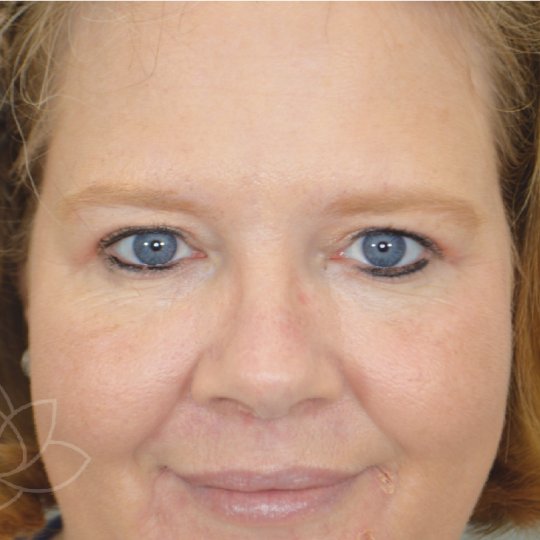 eyelid surgery for the aging face