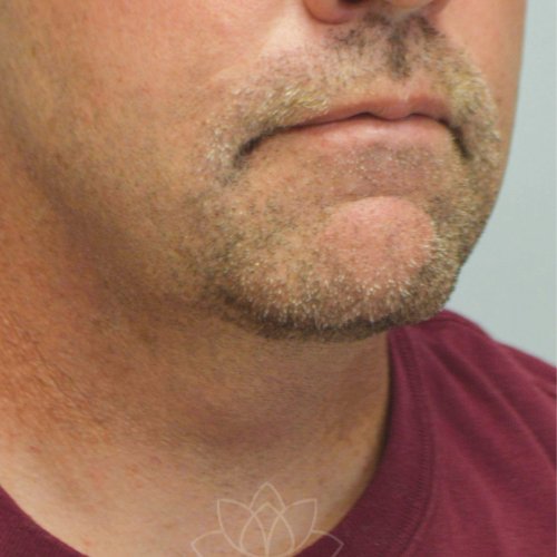 chin implant and neck lift