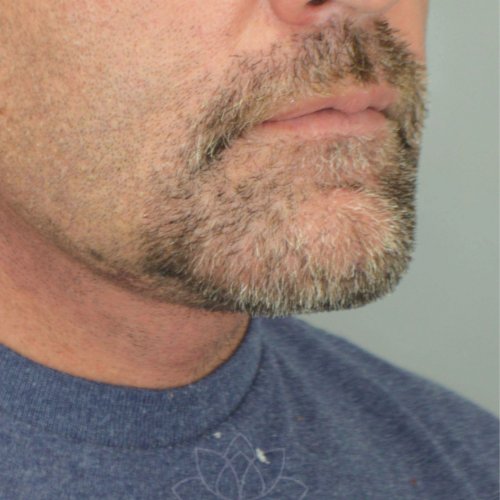 chin implant and neck lift at Desert Bloom Plastic Surgery