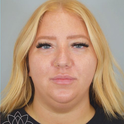 submental liposuction