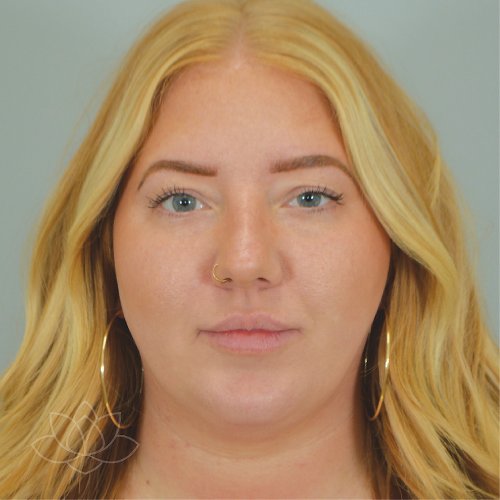 submental liposuction to treat a double chin