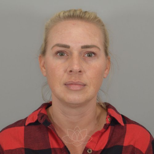 Submental Liposuction Before