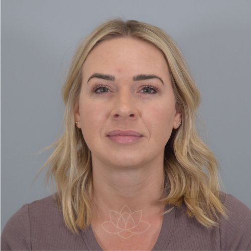 Submental Liposuction After