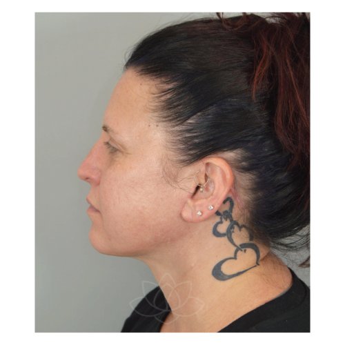 neck lift and submental liposuction at Desert Bloom Plastic Surgery