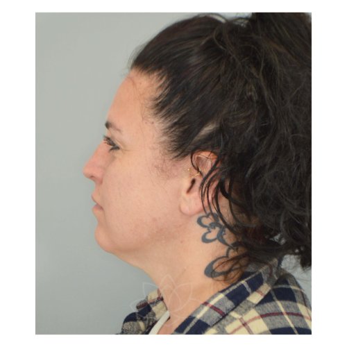 neck lift and submental liposuction at Desert Bloom Plastic Surgery