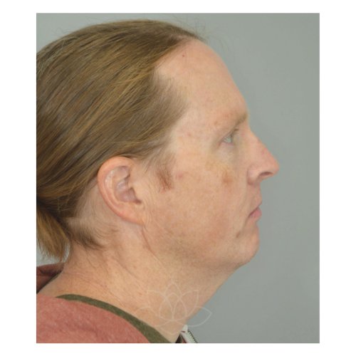 neck lift and submental liposuction at Desert Bloom Plastic Surgery