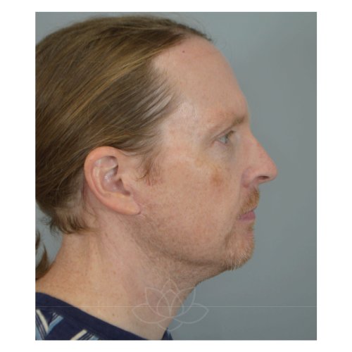 neck lift and submental liposuction at Desert Bloom Plastic Surgery