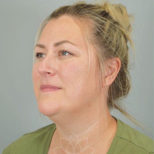 Neck Liposuction Before