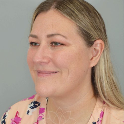 Neck Liposuction After