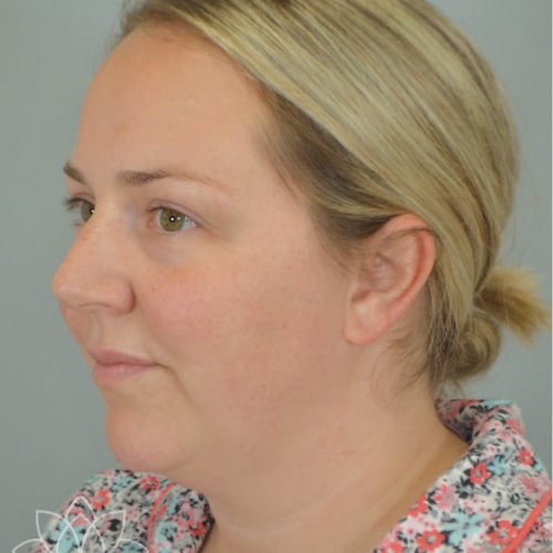 submental liposuction to treat a double chin