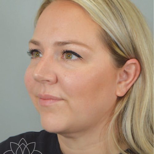 submental liposuction to treat a double chin